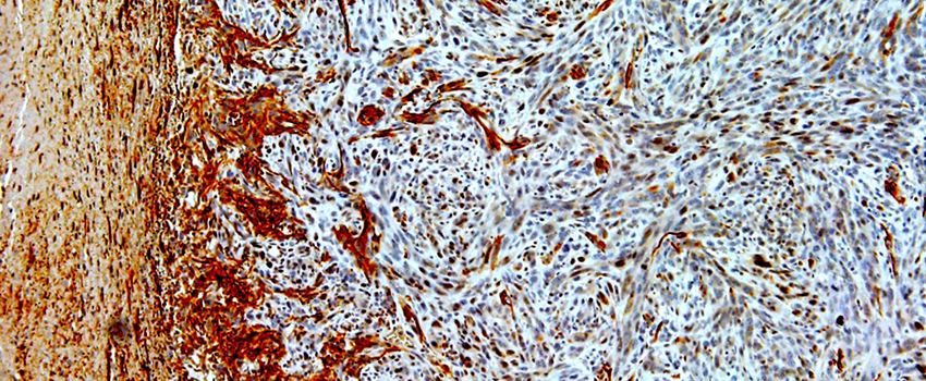 slide showing microscopic glioma cells